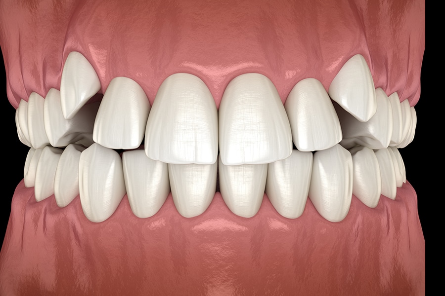 Example of Crowded Teeth Photo